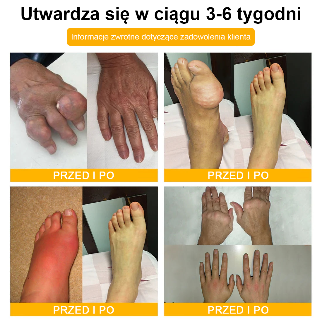 TLOPA® Toksyna botulinowa i jad pszczeli Krem przeciwbólowy do gojenia kości🦴