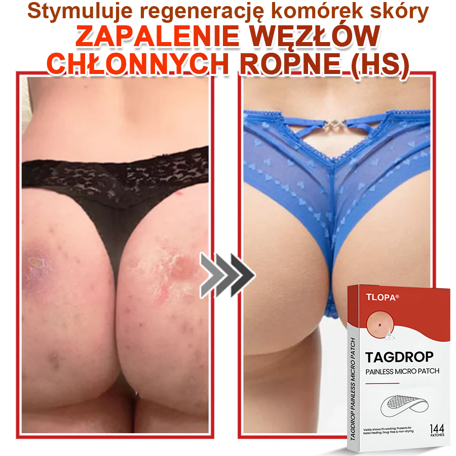 TLOPA® Mikroigłowy Botaniczny Plaster do Usuwania Narośli Skórnych 🇵🇱 Wyprodukowano w Polsce