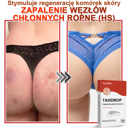 TLOPA® Mikroigłowy Botaniczny Plaster do Usuwania Narośli Skórnych 🇵🇱 Wyprodukowano w Polsce