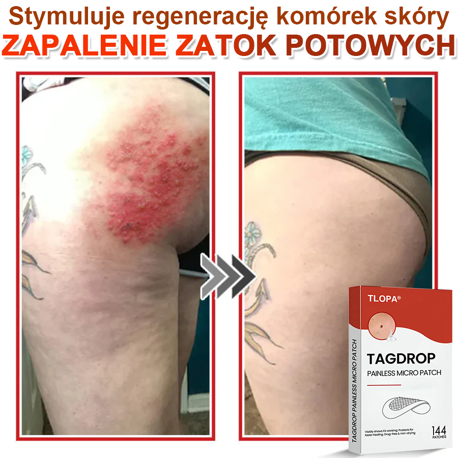 TLOPA® Mikroigłowy Botaniczny Plaster do Usuwania Narośli Skórnych 🇵🇱 Wyprodukowano w Polsce