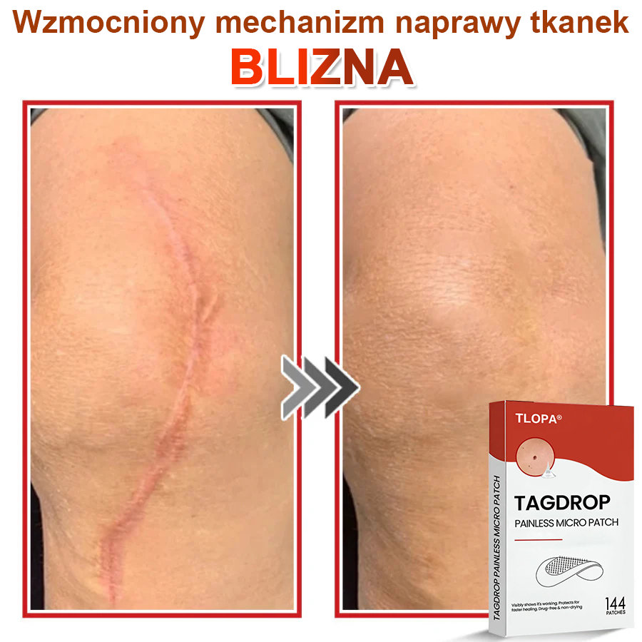 TLOPA® Mikroigłowy Botaniczny Plaster do Usuwania Narośli Skórnych 🇵🇱 Wyprodukowano w Polsce
