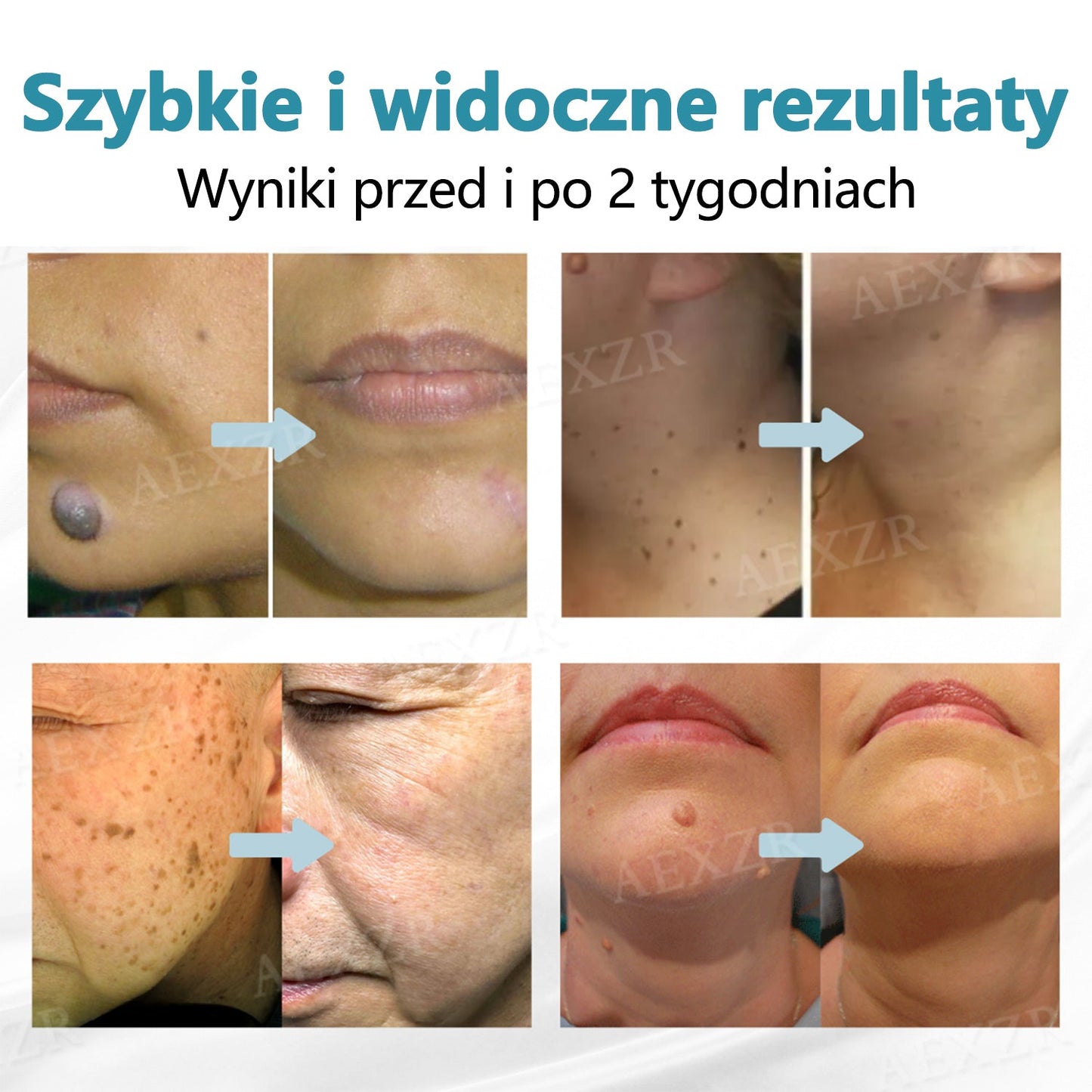 Cvreoz® nowy nieinwazyjny laser do usuwania pieprzyków i brodawek 🎉🎉