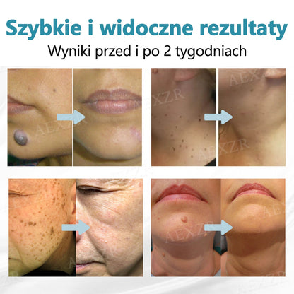 Cvreoz® nowy nieinwazyjny laser do usuwania pieprzyków i brodawek 🎉🎉