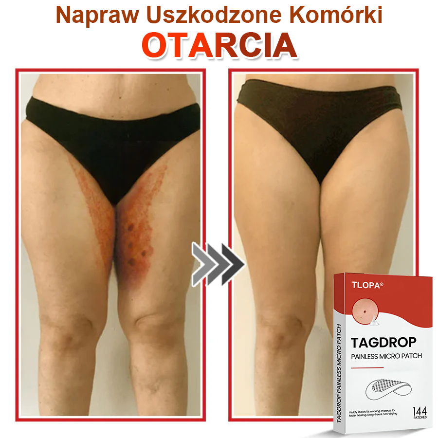 TLOPA® Mikroigłowy Botaniczny Plaster do Usuwania Narośli Skórnych 🇵🇱 Wyprodukowano w Polsce