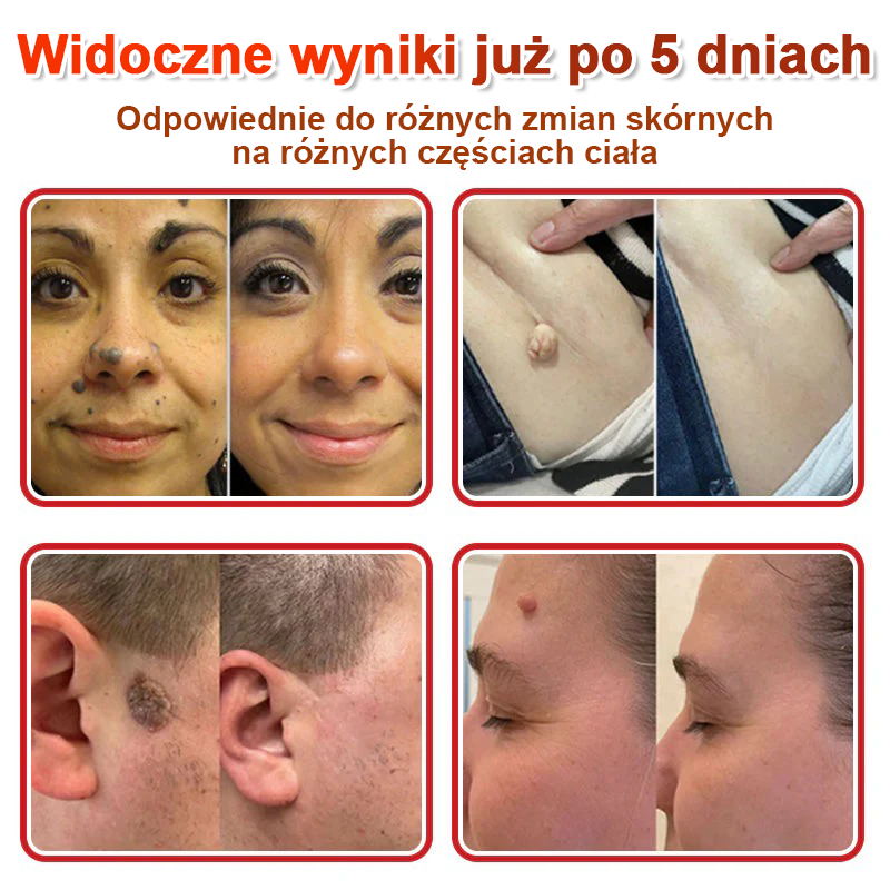 TLOPA® Mikroigłowy Botaniczny Plaster do Usuwania Narośli Skórnych 🇵🇱 Wyprodukowano w Polsce