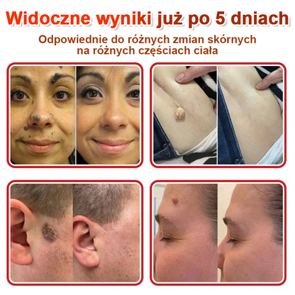 TLOPA® Mikroigłowy Botaniczny Plaster do Usuwania Narośli Skórnych 🇵🇱 Wyprodukowano w Polsce
