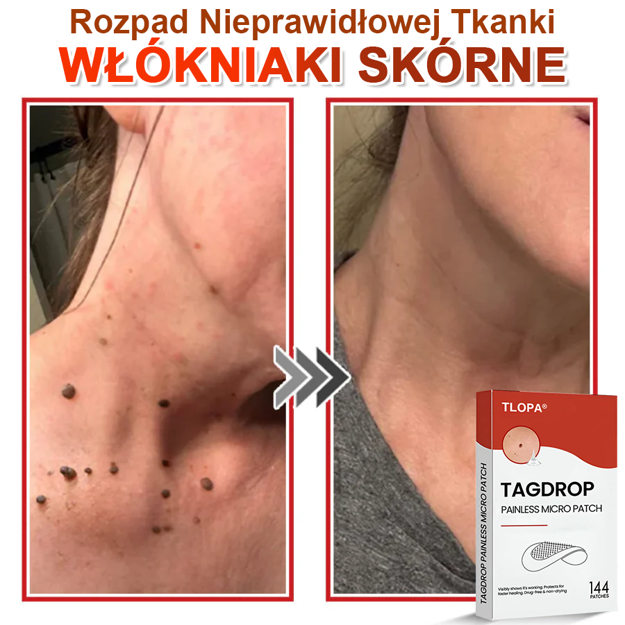 TLOPA® Mikroigłowy Botaniczny Plaster do Usuwania Narośli Skórnych 🇵🇱 Wyprodukowano w Polsce