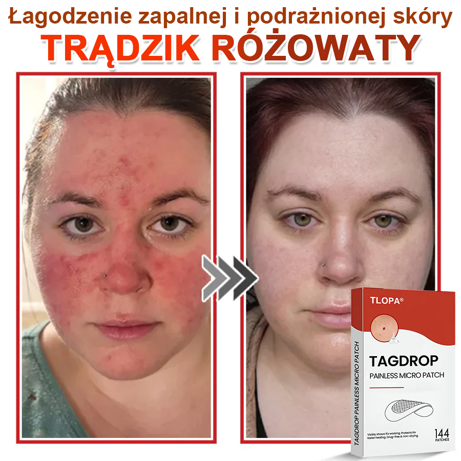 TLOPA® Mikroigłowy Botaniczny Plaster do Usuwania Narośli Skórnych 🇵🇱 Wyprodukowano w Polsce