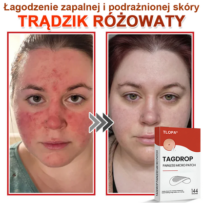 TLOPA® Mikroigłowy Botaniczny Plaster do Usuwania Narośli Skórnych 🇵🇱 Wyprodukowano w Polsce
