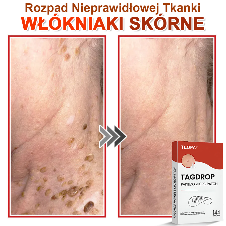 TLOPA® Mikroigłowy Botaniczny Plaster do Usuwania Narośli Skórnych 🇵🇱 Wyprodukowano w Polsce