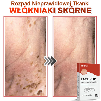 TLOPA® Mikroigłowy Botaniczny Plaster do Usuwania Narośli Skórnych 🇵🇱 Wyprodukowano w Polsce