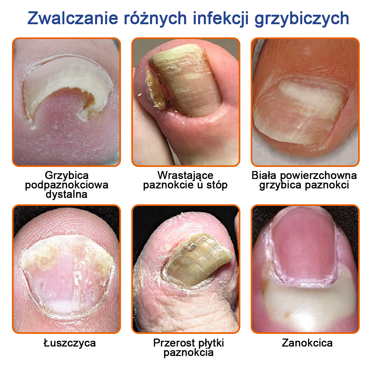 🐝Furzero™ Bienengift Nagelpilz Leczenie: Całkowite rozwiązanie problemu grzybicy paznokci🌟