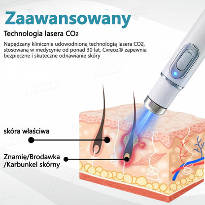 Cvreoz® nowy nieinwazyjny laser do usuwania pieprzyków i brodawek 🎉🎉