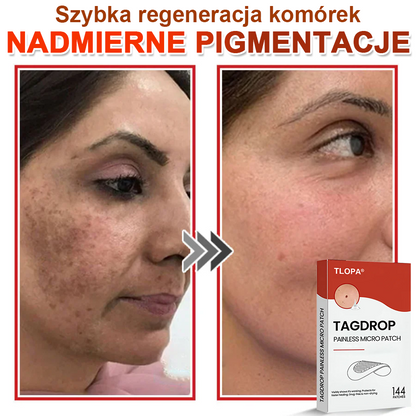 TLOPA® Mikroigłowy Botaniczny Plaster do Usuwania Narośli Skórnych 🇵🇱 Wyprodukowano w Polsce