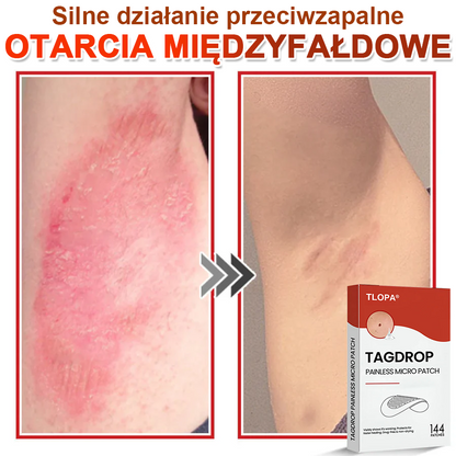 TLOPA® Mikroigłowy Botaniczny Plaster do Usuwania Narośli Skórnych 🇵🇱 Wyprodukowano w Polsce