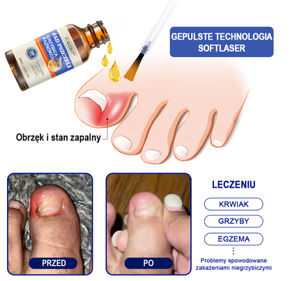🐝Furzero™ Bienengift Nagelpilz Leczenie: Całkowite rozwiązanie problemu grzybicy paznokci🌟
