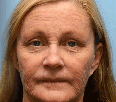FrissArc™ Botox Jadem Pszczelim przeciwzmarszczkowy Krem – Redukuje zmarszczki, ujędrnia i rozjaśnia skórę – Krem przeciwstarzeniowy o podwójnym działaniu✨
